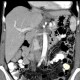 Lymphatic node, nodus foramen Winslowi, enlarged in hepatitis B and hepatitis C: CT - Computed tomography